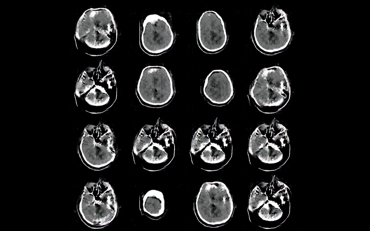 GAN data augmentation — brain hemorrhage CT dataset